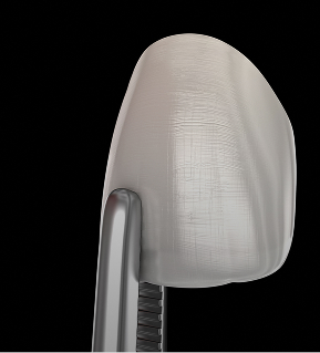 Facettes en composite direct