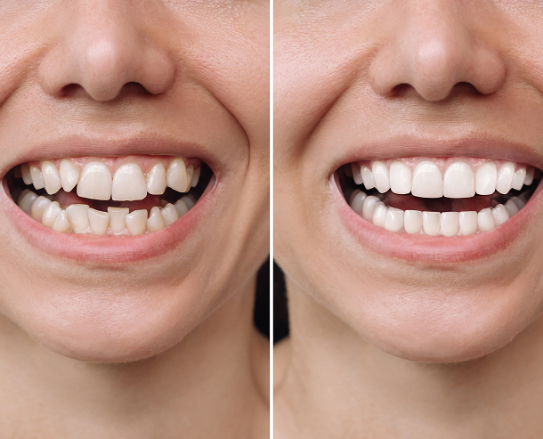 Quels problèmes peut-on corriger avec Invisalign ?
