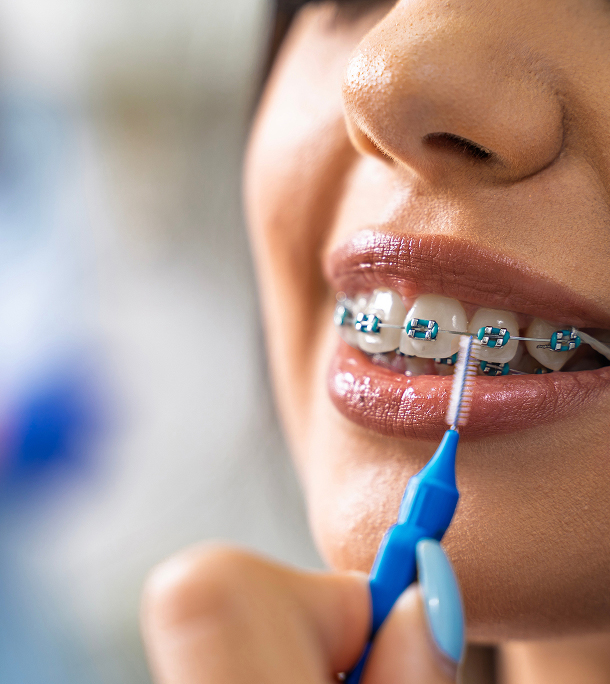 Pourquoi choisir les broches