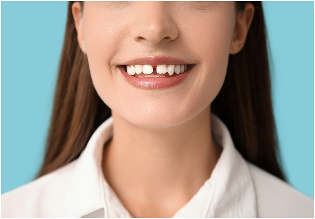 Pourquoi vouloir fermer un diastème Pourquoi vouloir fermer un diastème ?