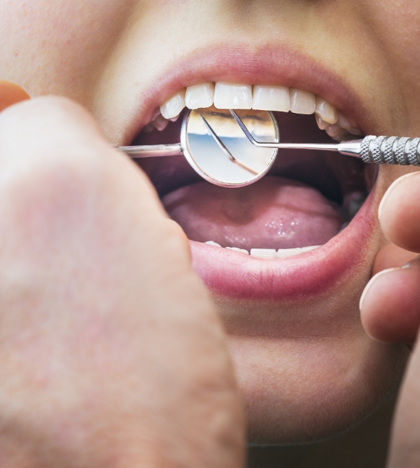 Comment traitons-nous les caries ?