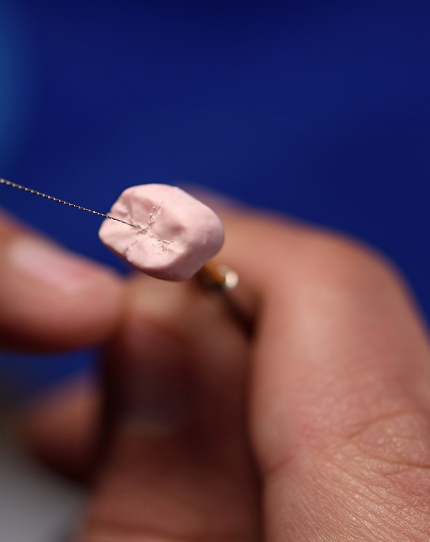 La couronne : protéger une dent affaiblie