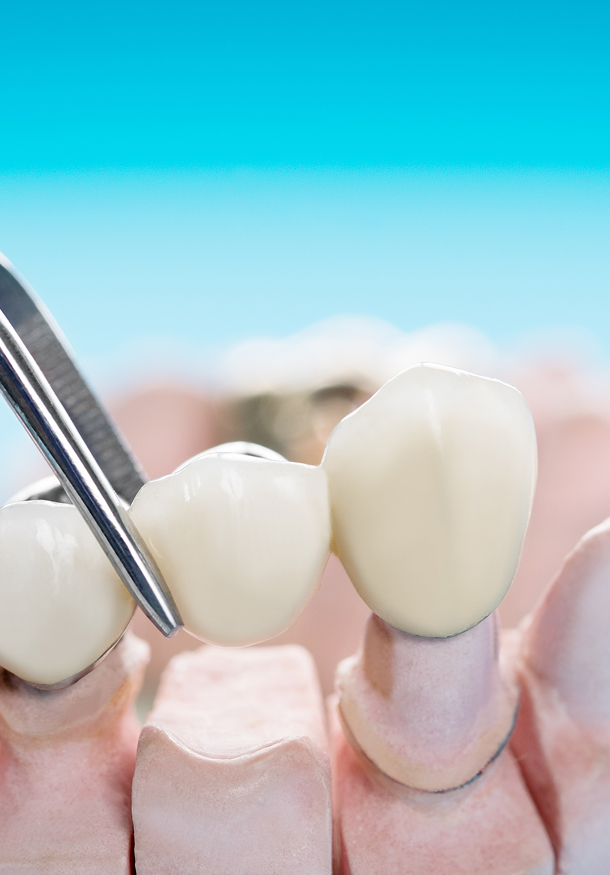 Le pont : remplacer une ou plusieurs dents manquantes