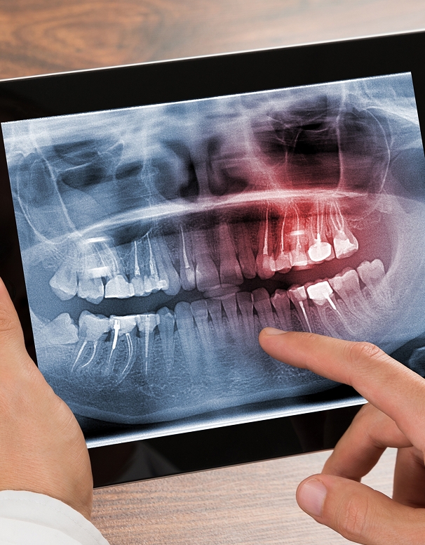 Pourquoi extraire les dents de sagesse ? Pourquoi extraire les dents de sagesse ?