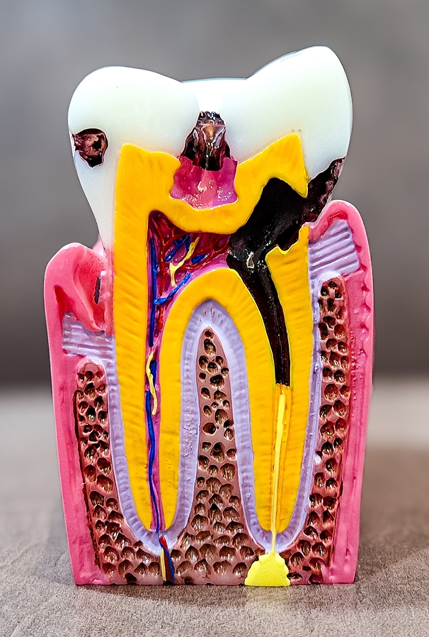 Quand a-t-on besoin d’un traitement de canal ? Quand a-t-on besoin d’un traitement de canal ?