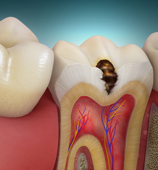 Qu’est-ce qu’une carie ?