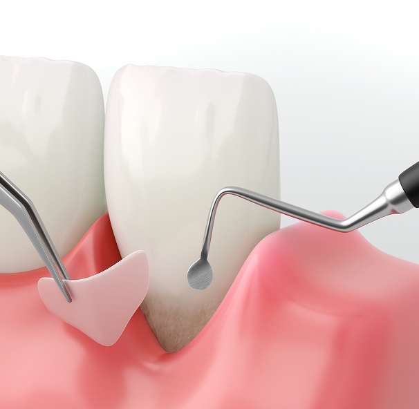 une greffe de gencive