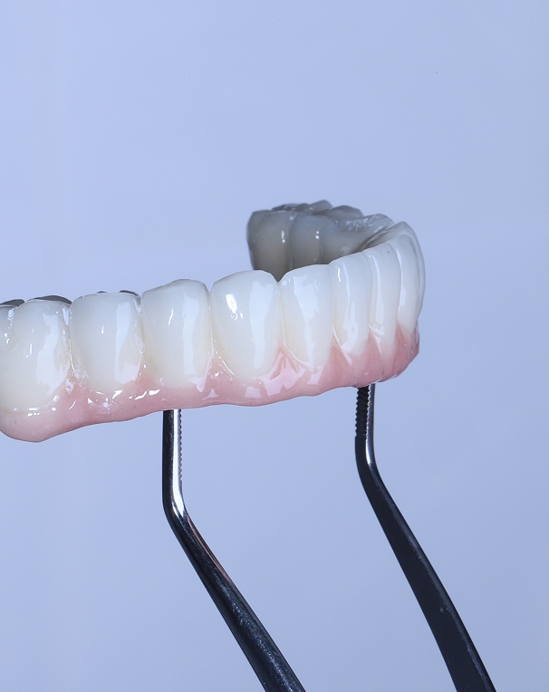 Qu’est-ce qu’une prothèse dentaire ?